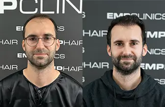 Transplante de Cabello